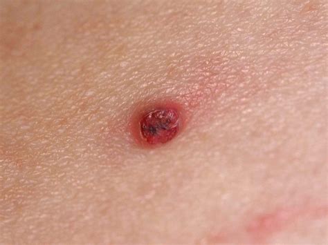 Skin Growths of Benign and Serious Conditions With Pictures