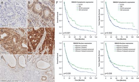 smad  heterogeneously expressed  gastric cancer   decreased