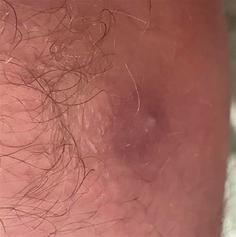 White dot surrounded by red circle on inner thigh. No pain/itch, but