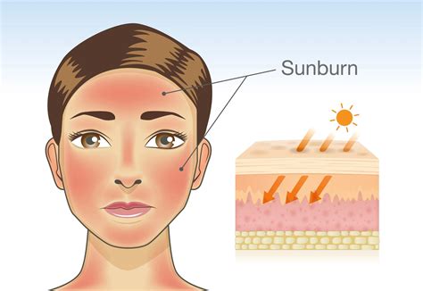 Follow The Sunburn Science – Sunburn Drink