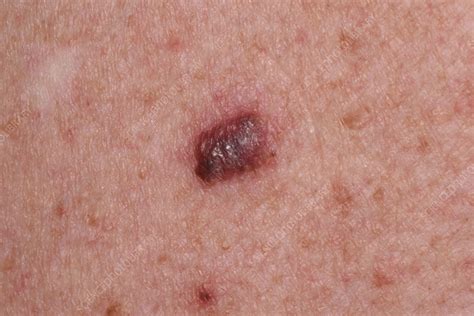 Malignant melanoma - Stock Image - C056/6586 - Science Photo Library