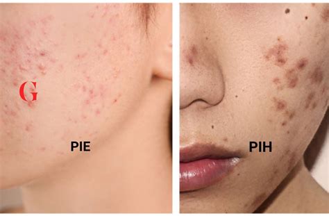 perbedaan noda bekas jerawat pie  pih glow mates