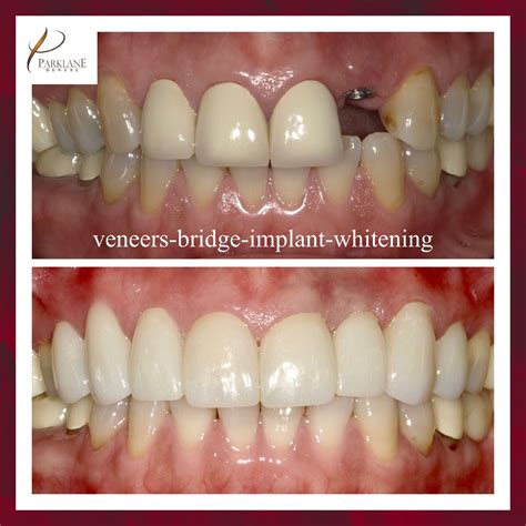 Dental Veneers Gallery | Before & After's | Parklane Dental