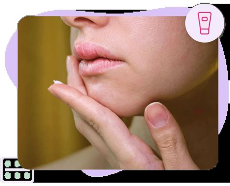 Cold Sores - PillSorted