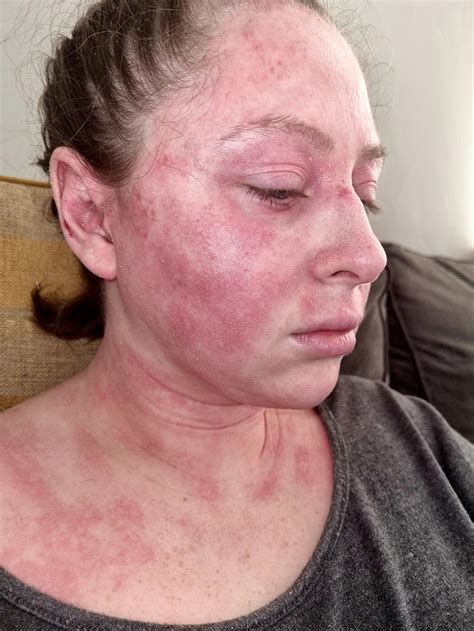 Eczema in babies: Woman left balding and bedbound by chronic condition ...