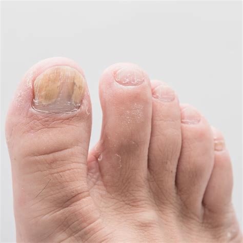Diabetic Toenails Turning White - Bios Pics
