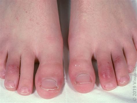 chilblains  symptoms treatment   goodrx
