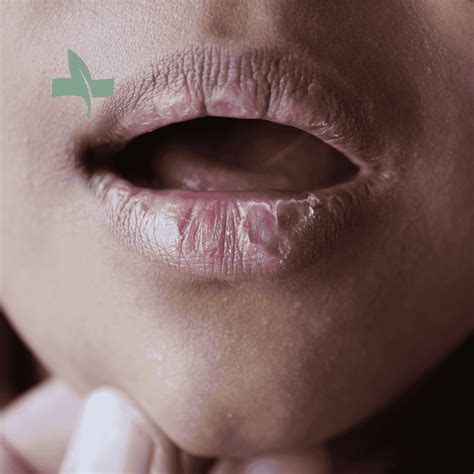 Rough Texture On Lips