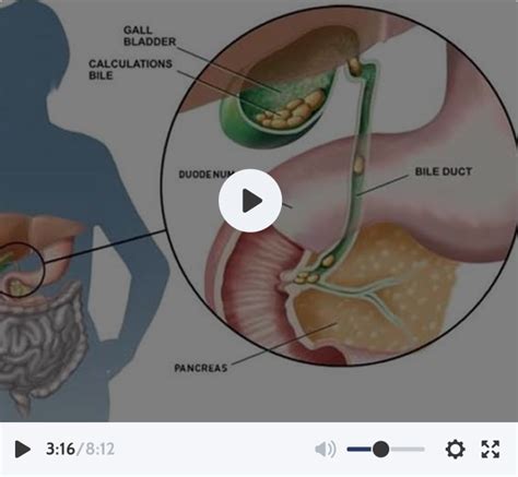 Achalasia Cardia Treatment in Delhi |Achalasia Cardia Surgery in Delhi