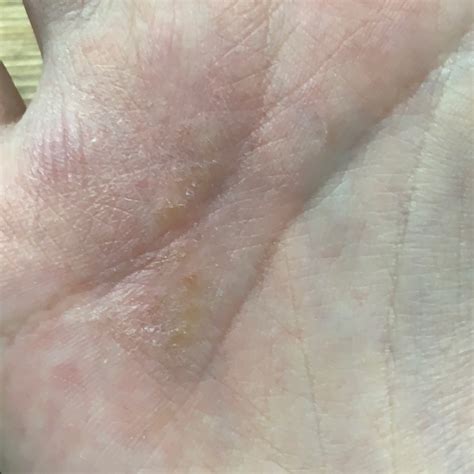 Infantile Eczema Icd 10 Codes at Melva Duran blog