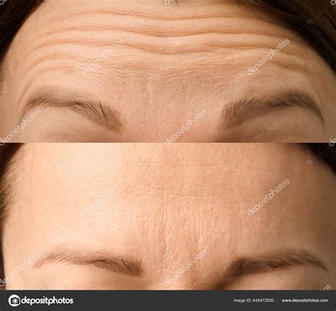 Wrinkles Close Facial Treatments Aging Program Concept Elimination ...