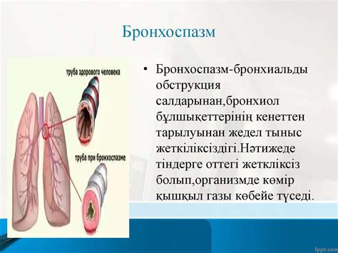 Ларингоспазм. Бронхоспазм - презентация онлайн