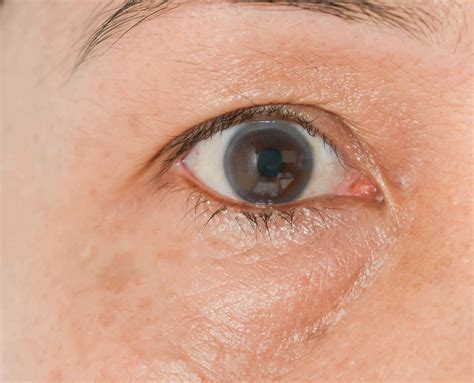 How Do I Get Rid Of My Puffy Eyes at Wallace Swindler blog
