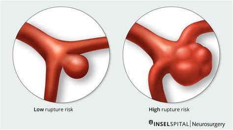 unruptured aneurysm   cerebral artery neurosurgery inselspital bern