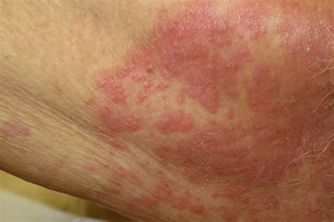 Symptoms of Fungal and Yeast Infections