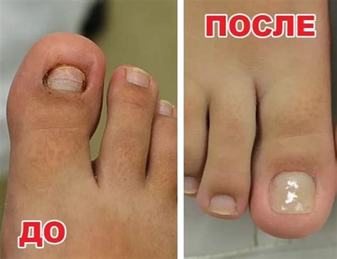 Восстановление ногтей после грибка на руках и ногах