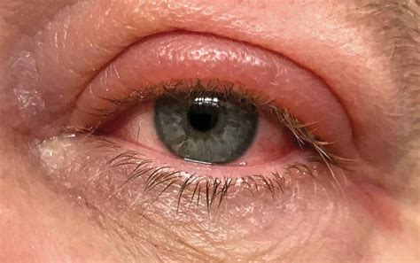 Olhos Inchados O Que Pode Ser - Olhos Inchados: Causas e Tratamentos | Cuidados Pela Vida
