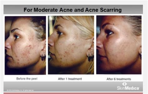 Refresh by Julie About SkinMedica Peels