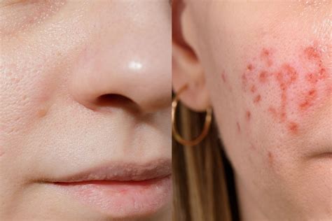 Laser Erbium Antes E Depois - Como é o antes e depois do laser Erbium? - Dra. Claudia Savassi