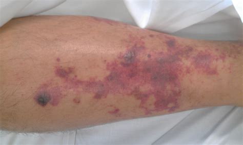 Reasons For Purpura