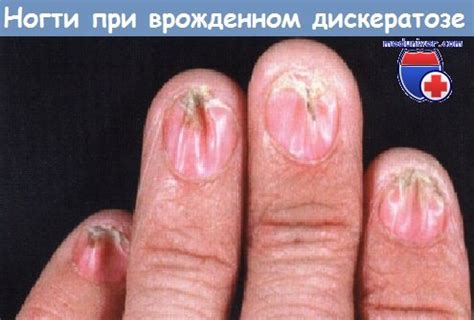 Врожденная атрофия ногтя и анонихия