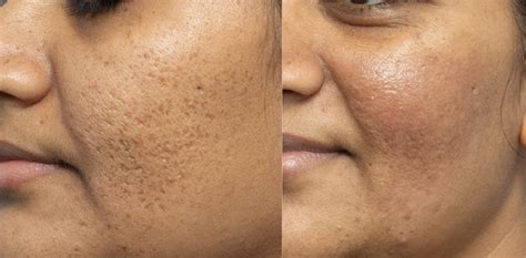 Best PIH post inflammatory hyperpigmentation treatments
