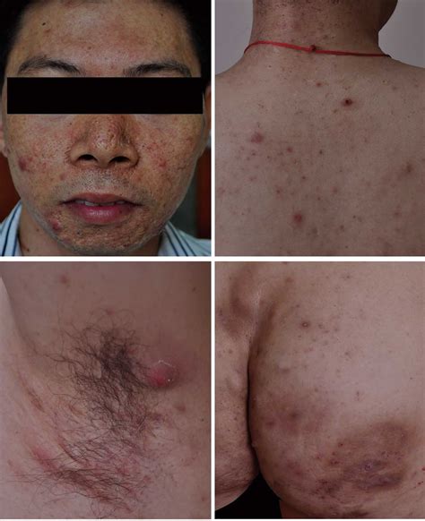 SAPHO syndrome causes, symptoms, diagnosis & treatment