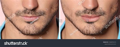 1,874 Hyaluronic Acid Before After Images, Stock Photos & Vectors ...