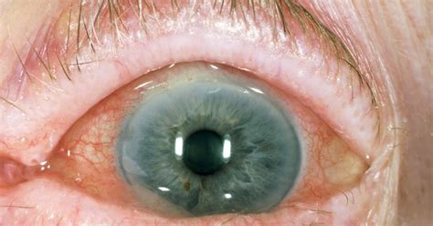 Flaky Eyelids: Causes and Risk Factors