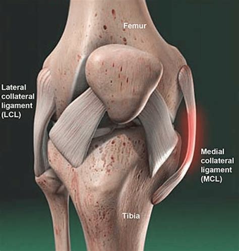 medial collateral ligament mcl injuries ismi