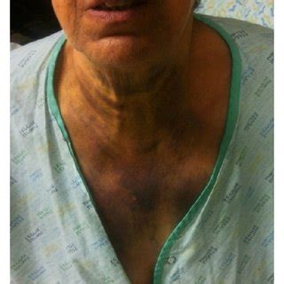 The picture was taken on the second day of hospitalization: hematoma ...