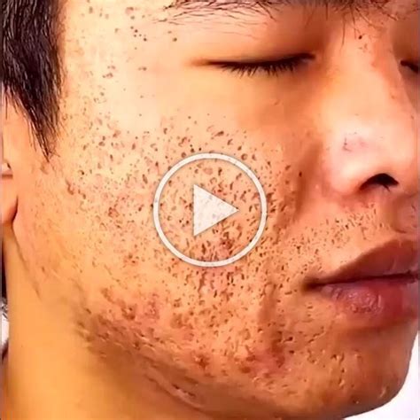 Muitos Cravos No Rosto - 22 HealthySkinblosy7 | Cravos no rosto, Cuidados com pele saudável