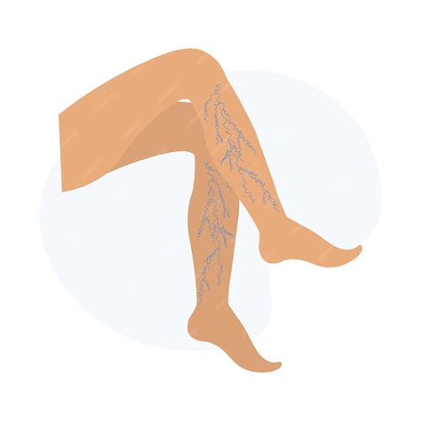 Premium Vector | Varicose veins in the legs Vascular or spider veins