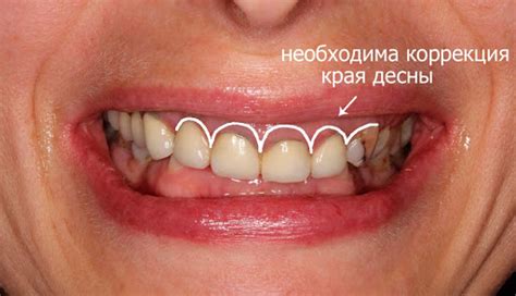 Пластика слизистой полости рта в Днепре - Дентал Евро