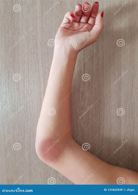 Painful Allergic Reaction To a Wasp Sting Stock Image - Image of