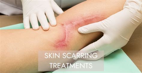 effective scar treatments  bromley beutiva skin clinic