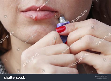 how to know if i have herpes on my lip