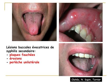 syphilis diagnostic clinique  powerpoint