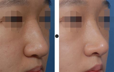 bulbous nose rhinoplasty hanabi rhinoplasty clinic