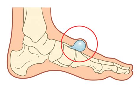 gigroma priciny poiavleniia simptomy zabolevaniia diagnostika