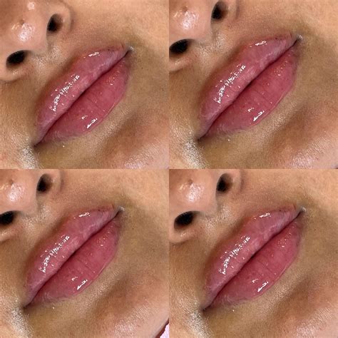 B’tox and Lip Fillers, Birmingham Medical Aesthetics - Our client had