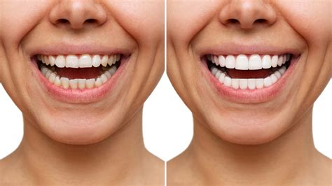 veneers granite belt dental