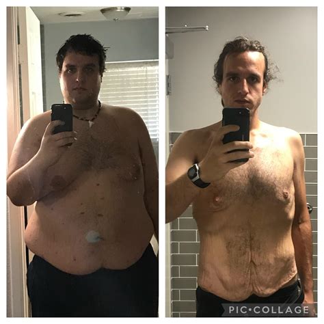 M/31/6’1 [480>180= 300 lbs] I used to be embarrassed by my extra skin