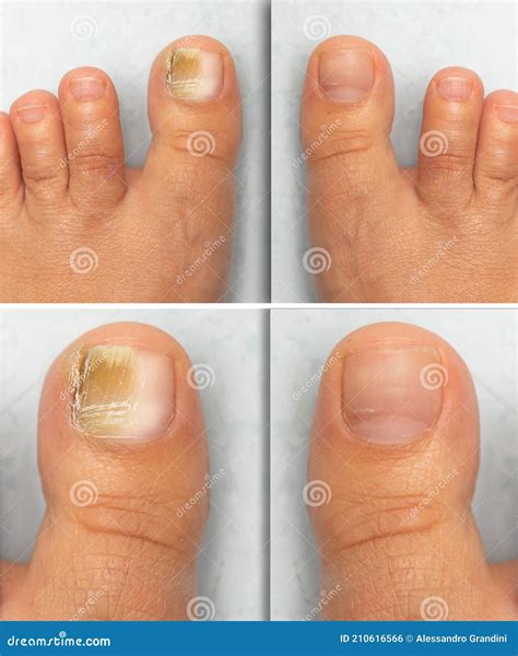 MYCOSIS TREATMENT With Antifungal Powder Stock Image | CartoonDealer