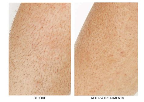 Best Laser Hair Removal Toronto | Laser Hair Removal Near Me