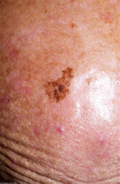 Dermoscopy Atlas | Diagnosis Detail