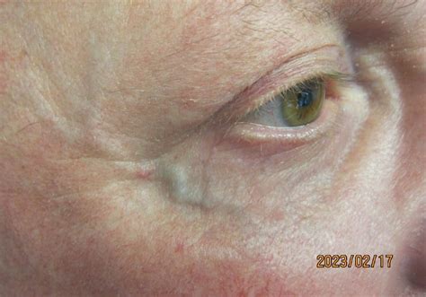Under Eye Vein Removal | Solihull Cosmetic Clinic