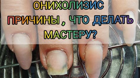 Онихолизис😱Как поступить мастеру? Причины онихолизиса. Коррекция ногтей ...