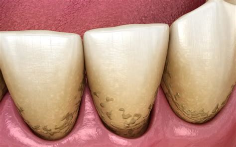 Zubni plak | Zubni biofilm - Dentus perfectus ordinacija