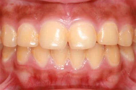 Yellow Teeth, Stains, Pictures, Causes, Prevention, Treatment & Home ...